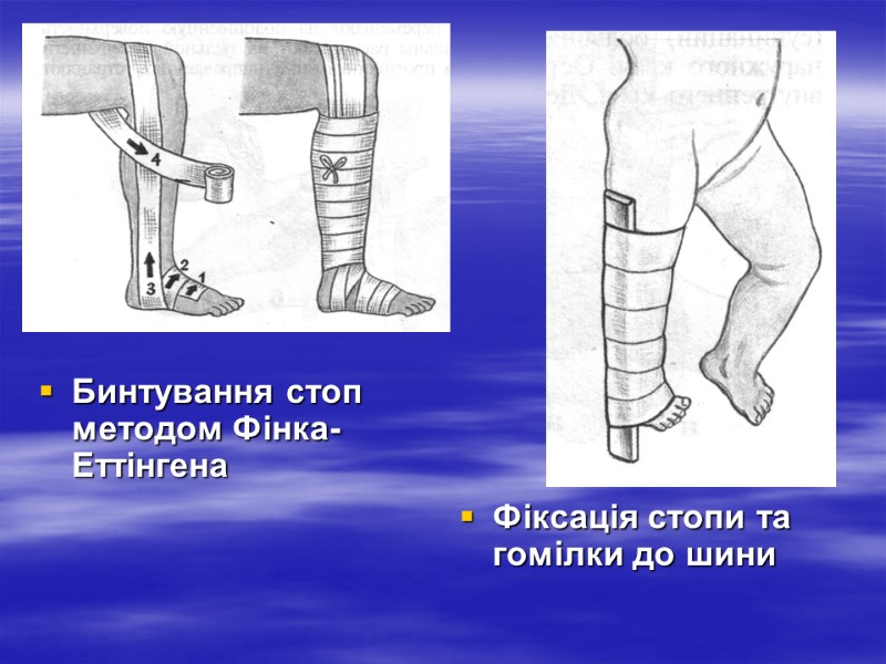 Бинтування стоп методом Фінка-Еттінгена Фіксація стопи та гомілки до шини